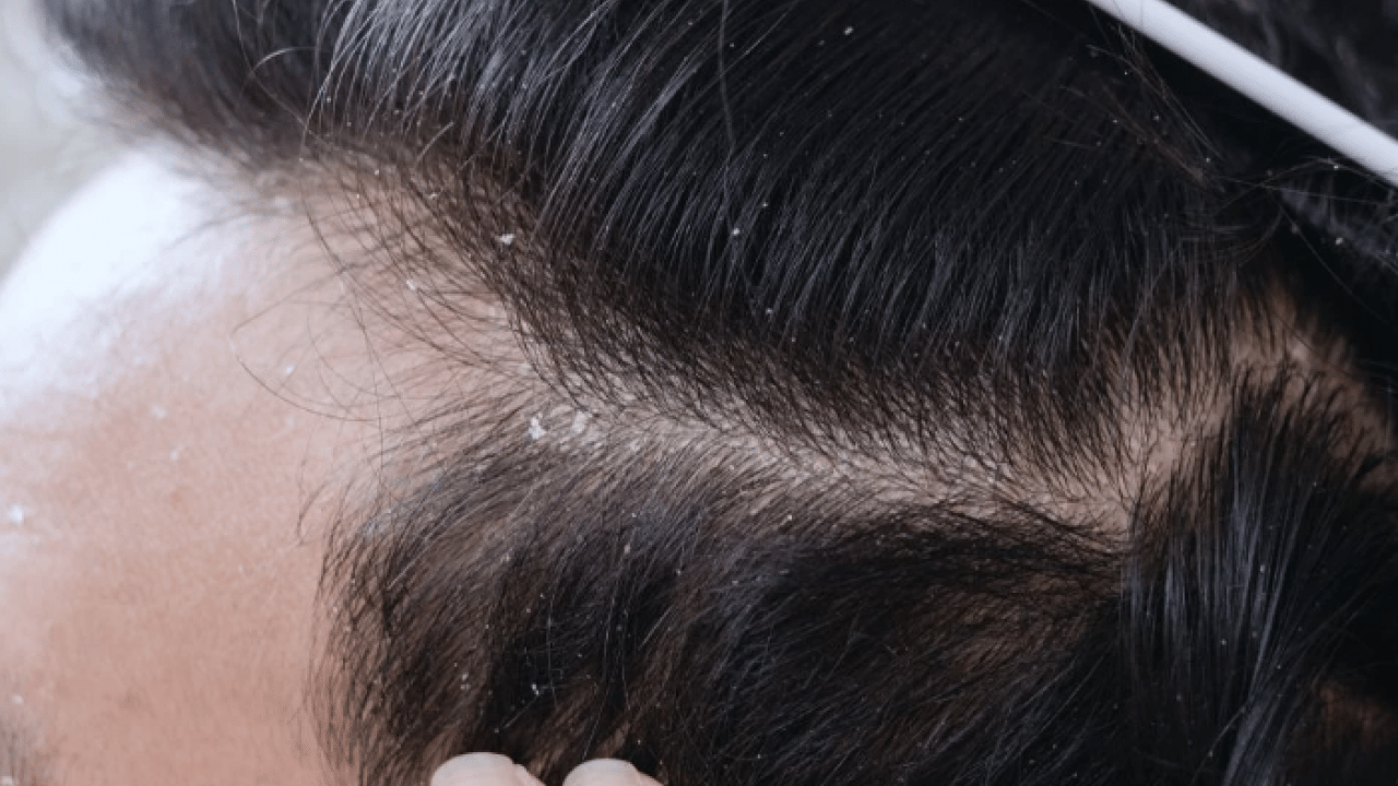 Foto - Dakikalar içinde sorunu çözecek! Saç kepeğinden kurtulmanın doğal yolu açıklandı