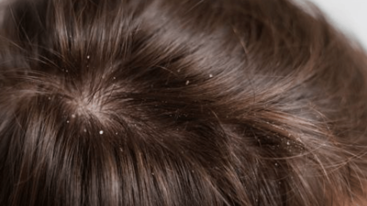 Dakikalar içinde sorunu çözecek! Saç kepeğinden kurtulmanın doğal yolu açıklandı