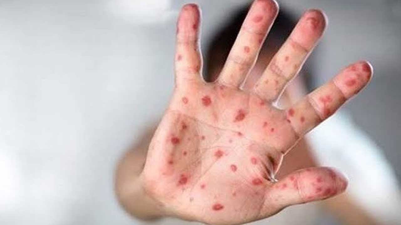 Foto - Dehşete düşüren haber! Kızamık salgınında ölen çocuk sayısı 779'a yükseldi