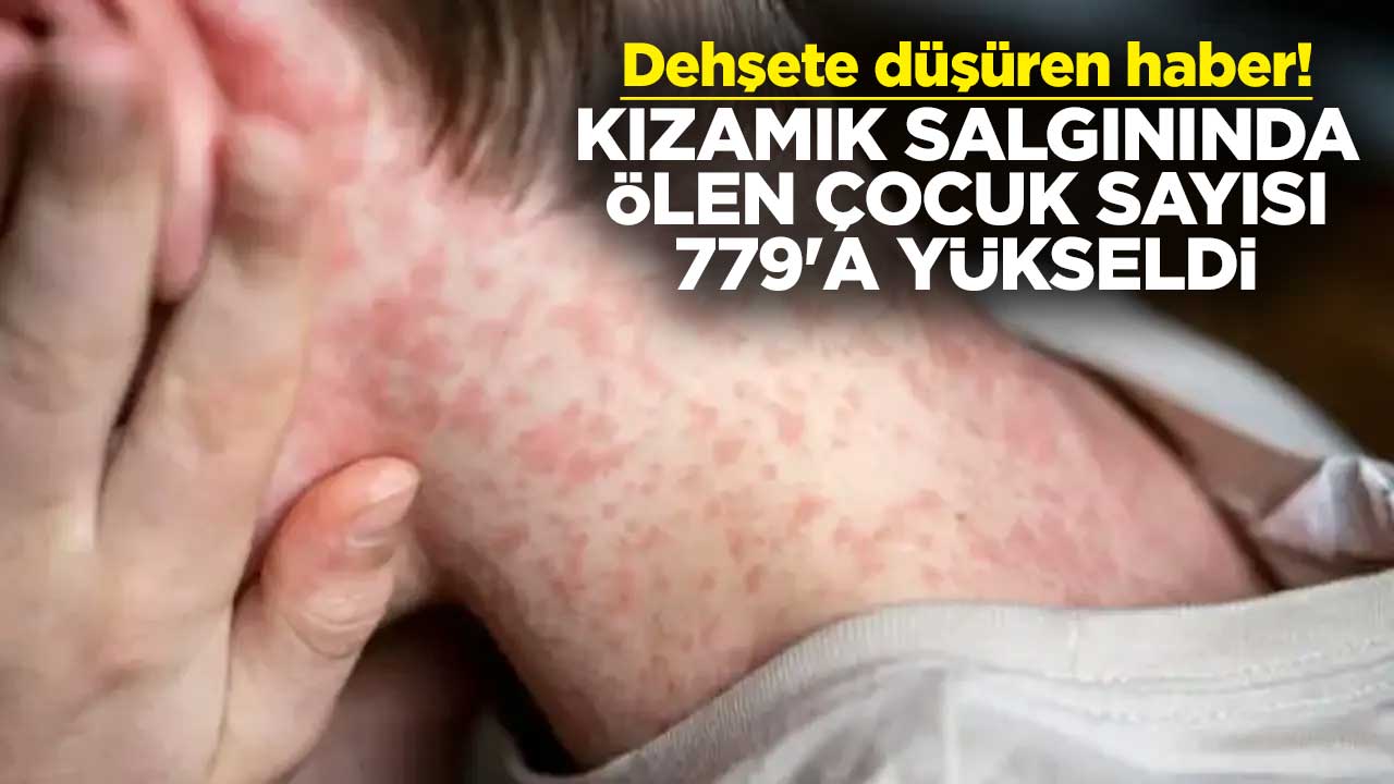 Dehşete düşüren haber! Kızamık salgınında ölen çocuk sayısı 779'a yükseldi