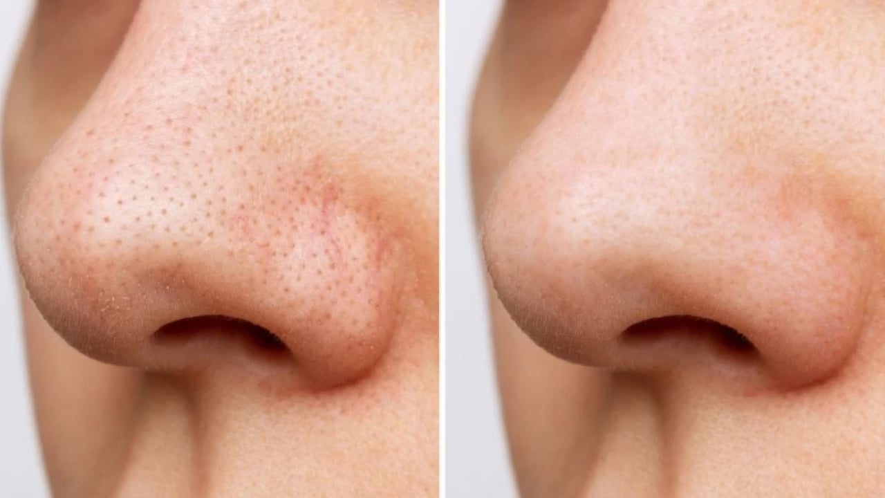 Foto - Deneyince farkını göreceksiniz! Cildinizdeki siyah noktalardan kurtulmanın doğal yolu