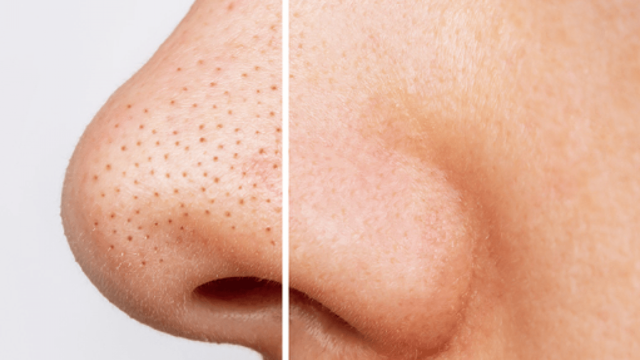 Deneyince farkını göreceksiniz! Cildinizdeki siyah noktalardan kurtulmanın doğal yolu
