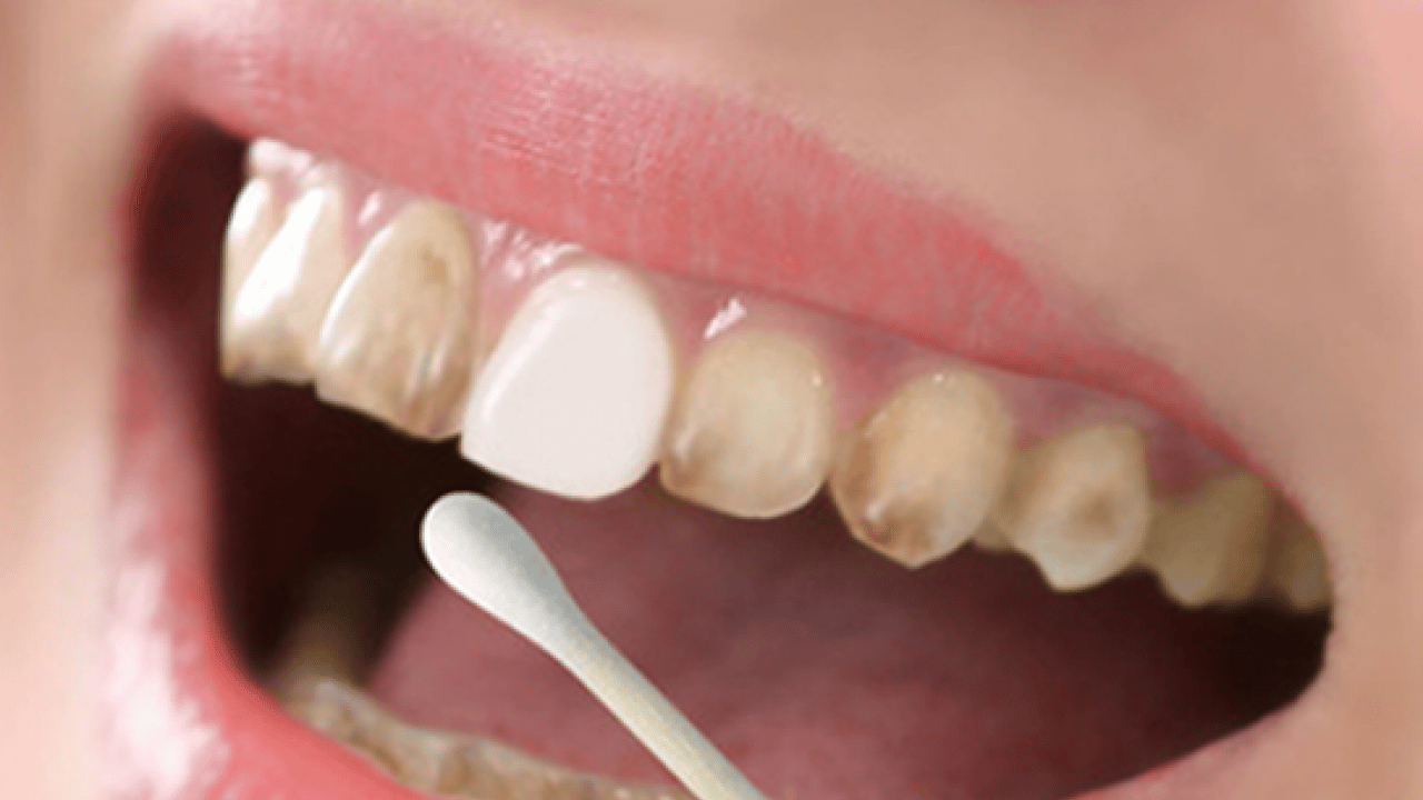 Deneyince farkını göreceksiniz! İşte sararan dişleri beyazlatan yöntem