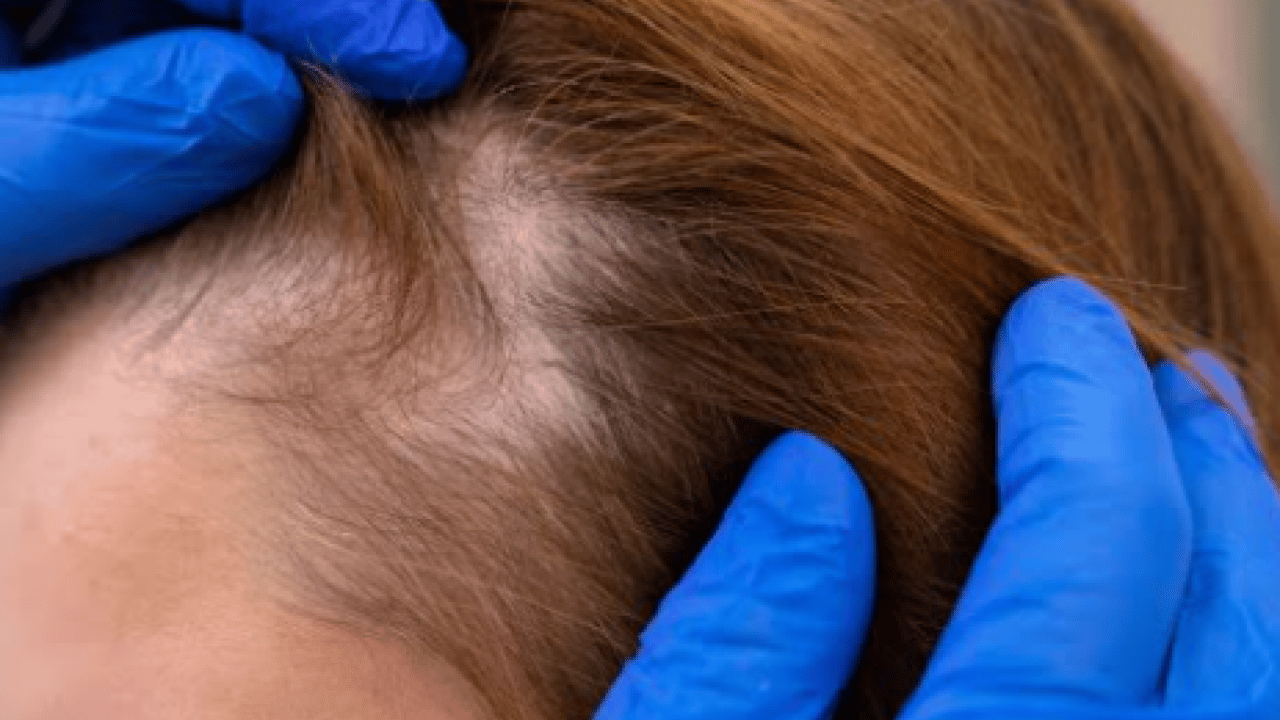 Deneyince farkını göreceksiniz! Saç dökülmesine karşı doğal yöntem açıklandı