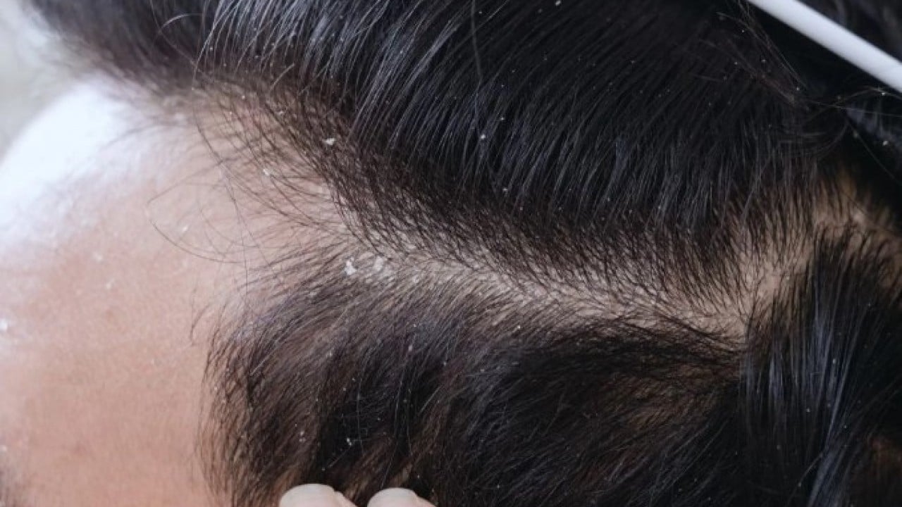 Foto - Deneyince farkını göreceksiniz! Saç kepeğinden sonsuza dek kurtaran yöntem