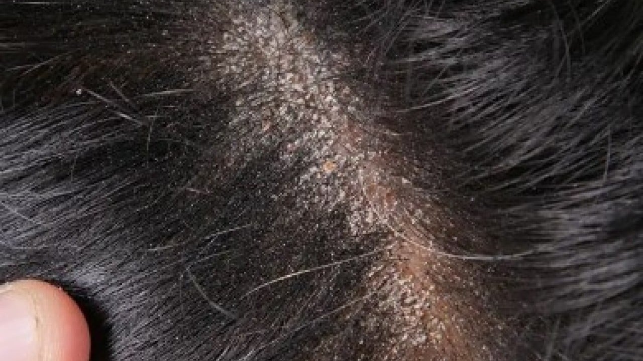 Deneyince farkını göreceksiniz! Saç kepeğinden sonsuza dek kurtaran yöntem