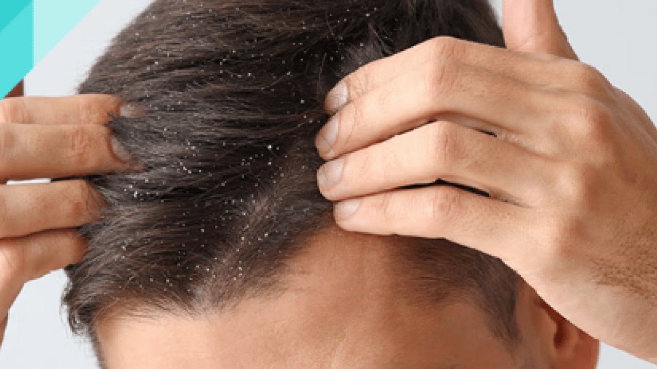 Deneyince farkını göreceksiniz! Saçları kepekten kurtaran doğal yöntem açıklandı