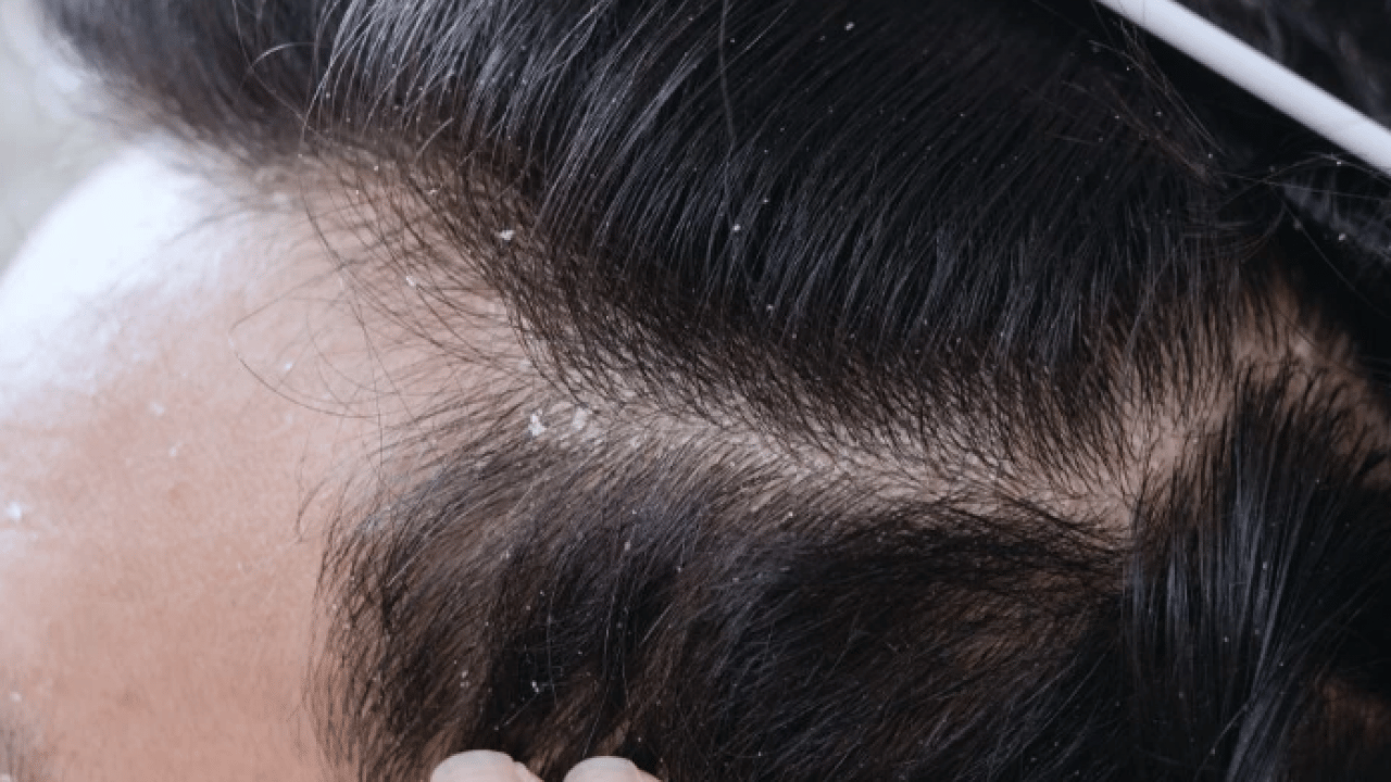 Foto - Deneyince farkını göreceksiniz! Saçları kepekten kurtaran doğal yöntem açıklandı