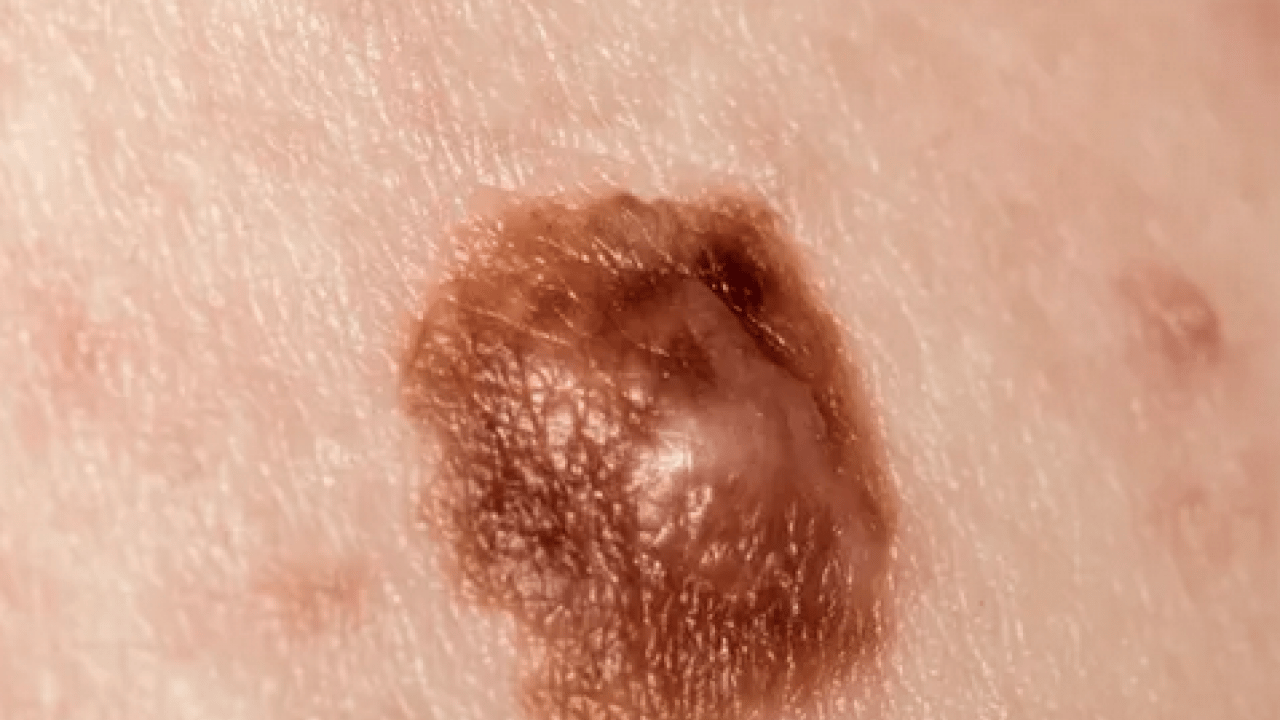 Foto - Derideki masum görünen benlere dikkat: Ailede melanom öyküsü bulunması...