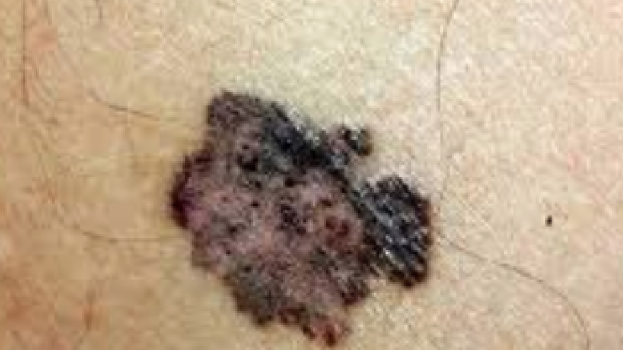 Foto - Derideki masum görünen benlere dikkat: Ailede melanom öyküsü bulunması...