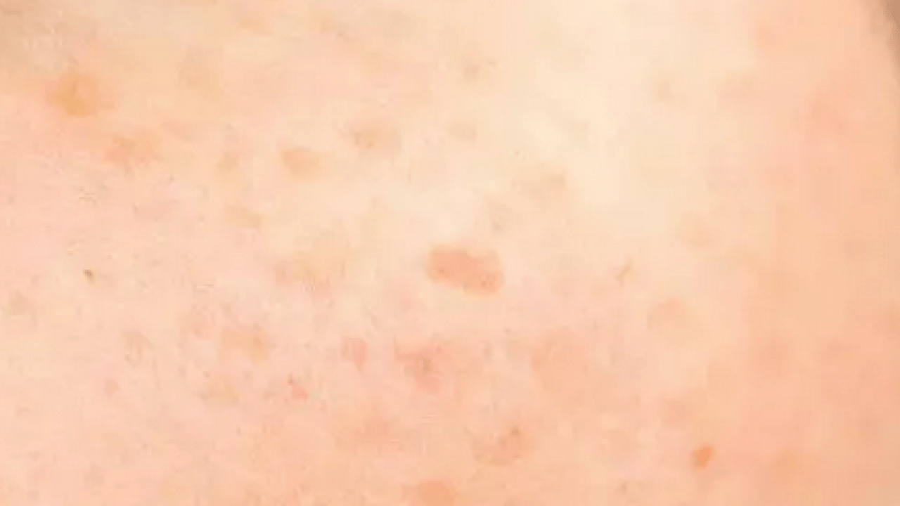 Foto - Derideki masum görünen benlere dikkat: Ailede melanom öyküsü bulunması...