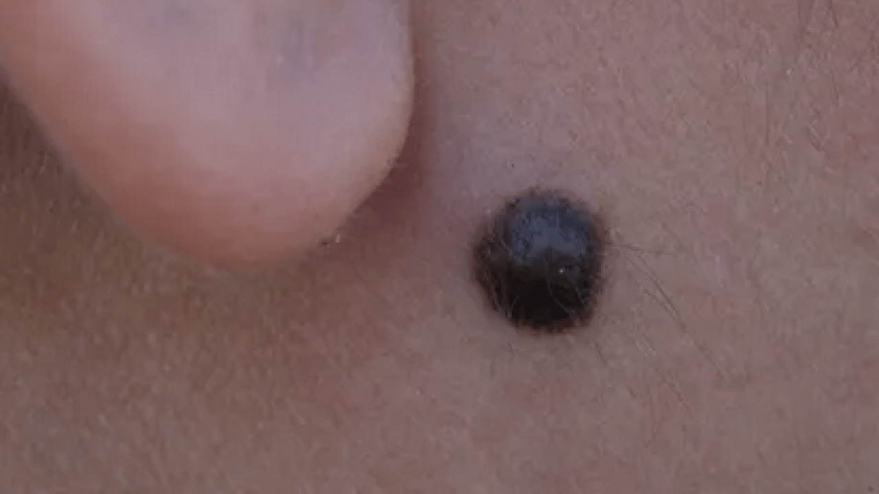 Foto - Derideki masum görünen benlere dikkat: Ailede melanom öyküsü bulunması...