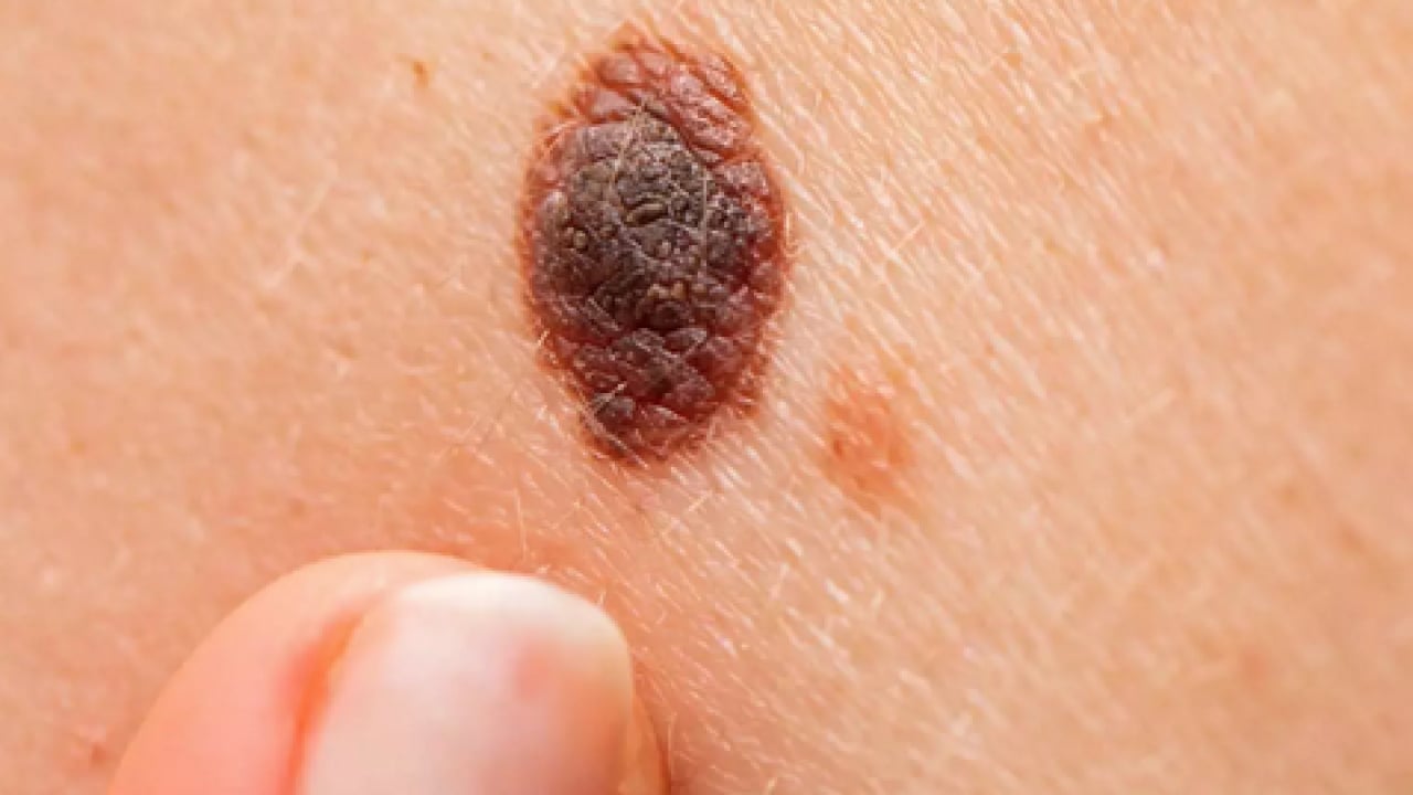 Foto - Derideki masum görünen benlere dikkat: Ailede melanom öyküsü bulunması...