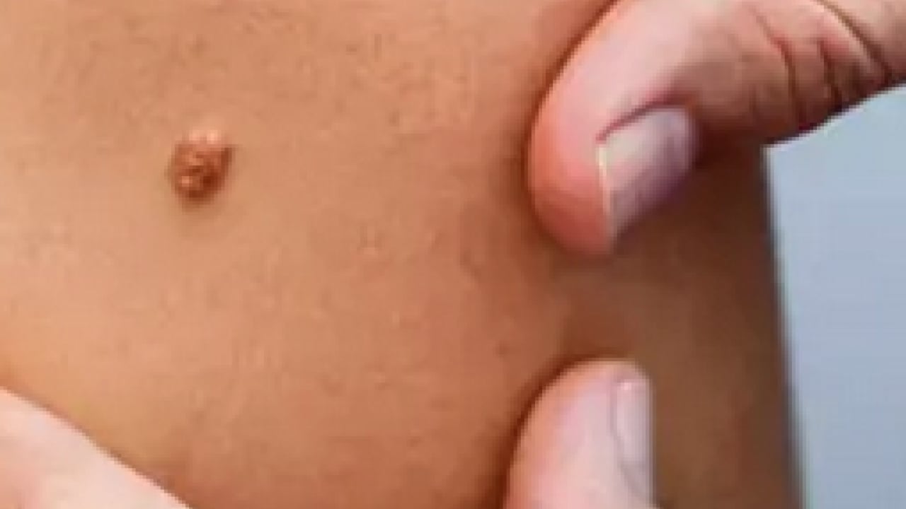 Foto - Derideki masum görünen benlere dikkat: Ailede melanom öyküsü bulunması...