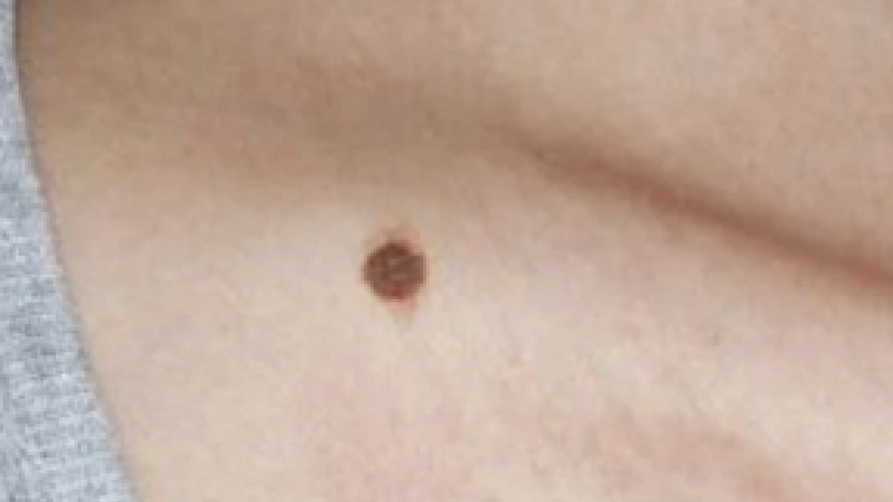 Foto - Derideki masum görünen benlere dikkat: Ailede melanom öyküsü bulunması...