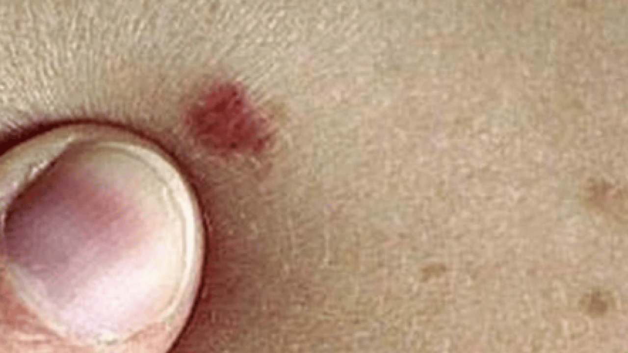 Derideki masum görünen benlere dikkat: Ailede melanom öyküsü bulunması...