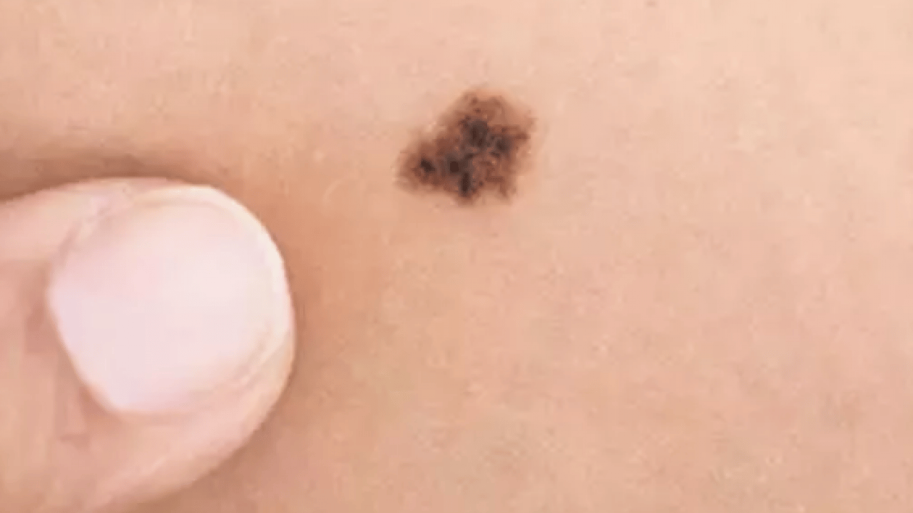 Foto - Derideki masum görünen benlere dikkat: Ailede melanom öyküsü bulunması...