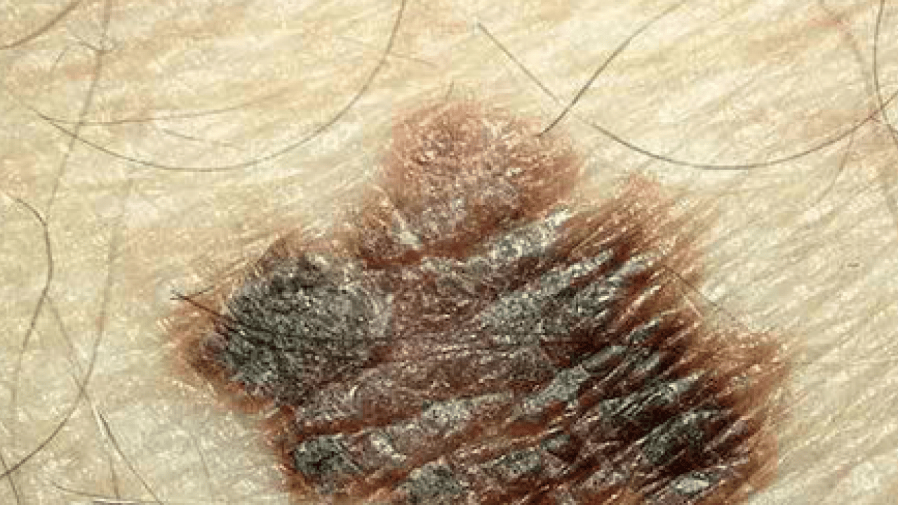 Foto - Derideki masum görünen benlere dikkat: Ailede melanom öyküsü bulunması...