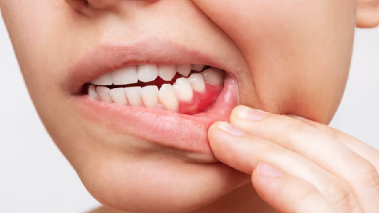 Foto - Diş eti kanamalarına son: Doğal ilacı çıktı! Diş etlerine bal sürmek dişçiden kurtarıyor...