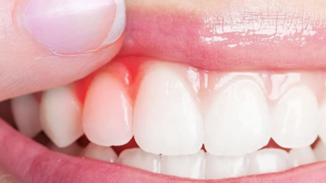 Foto - Diş eti kanamalarına son: Doğal ilacı çıktı! Diş etlerine bal sürmek dişçiden kurtarıyor...