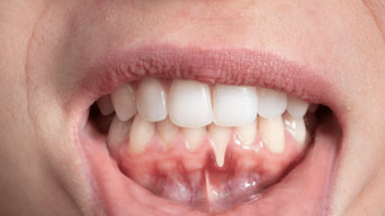 Diş eti kanamalarına son: Doğal ilacı çıktı! Diş etlerine bal sürmek dişçiden kurtarıyor...