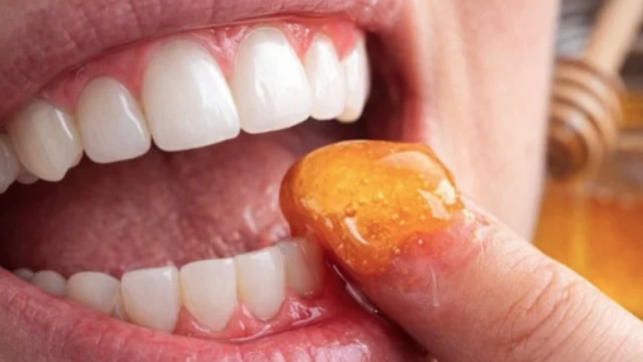 Foto - Diş eti kanamalarına son: Doğal ilacı çıktı! Diş etlerine bal sürmek dişçiden kurtarıyor...