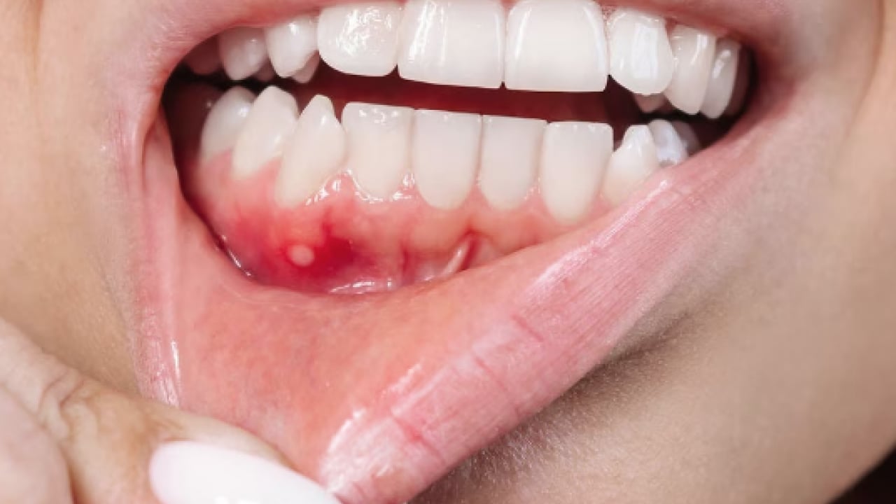 Foto - Diş eti kanamalarına son: Doğal ilacı çıktı! Diş etlerine bal sürmek dişçiden kurtarıyor...