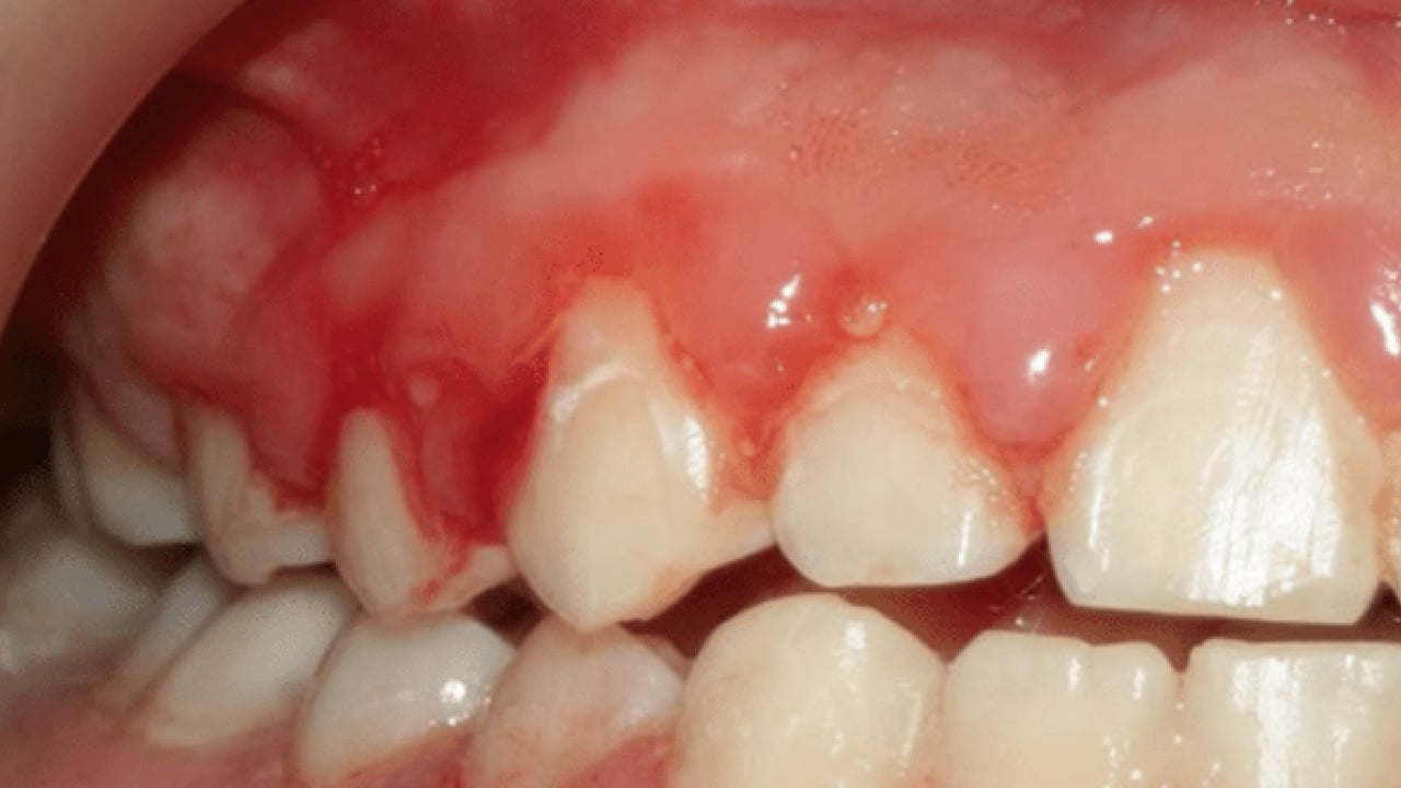 Foto - Diş eti kanamalarına son: Doğal ilacı çıktı! Diş etlerine bal sürmek dişçiden kurtarıyor...