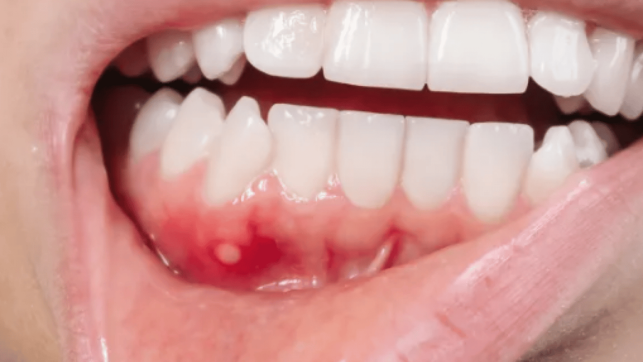 Foto - Diş eti kanamalarına son: Doğal ilacı çıktı! Diş etlerine bal sürmek dişçiden kurtarıyor...