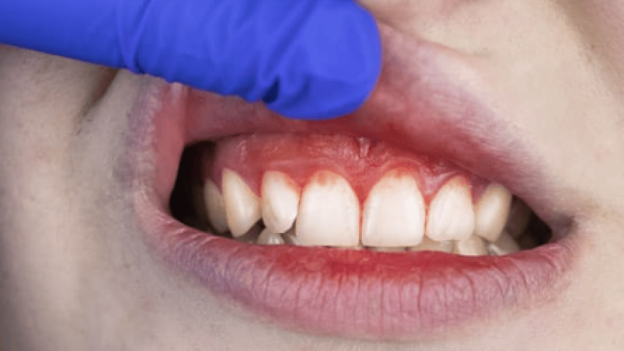 Diş fırçalarken kan mı geliyor? Aman dikkat! İşte diş eti iltihabını geçiren yöntemler