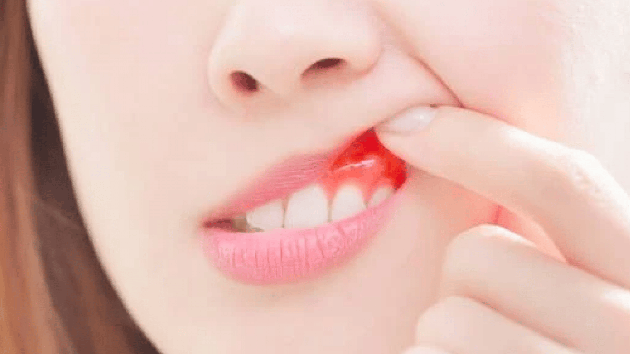 Foto - Diş fırçalarken kan mı geliyor? Aman dikkat! İşte diş eti iltihabını geçiren yöntemler