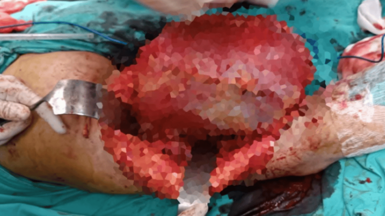 Foto - Doktorlar bile inanamadı! Bacağından çıkan şey tam 5 kilo 668 gram