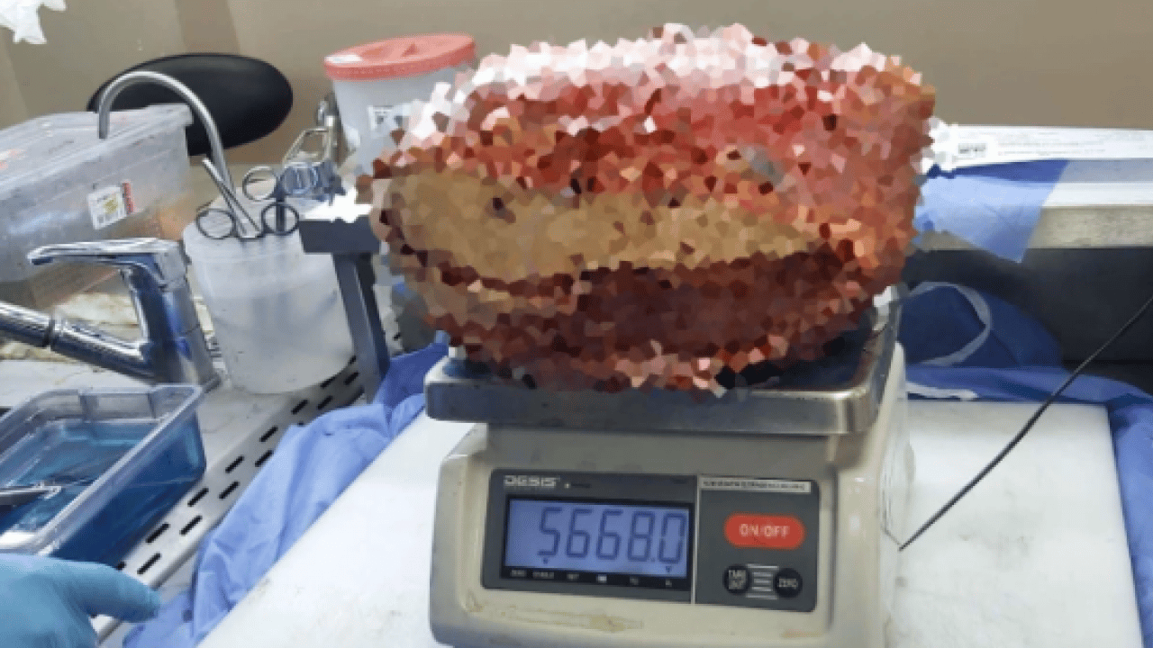 Foto - Doktorlar bile inanamadı! Bacağından çıkan şey tam 5 kilo 668 gram