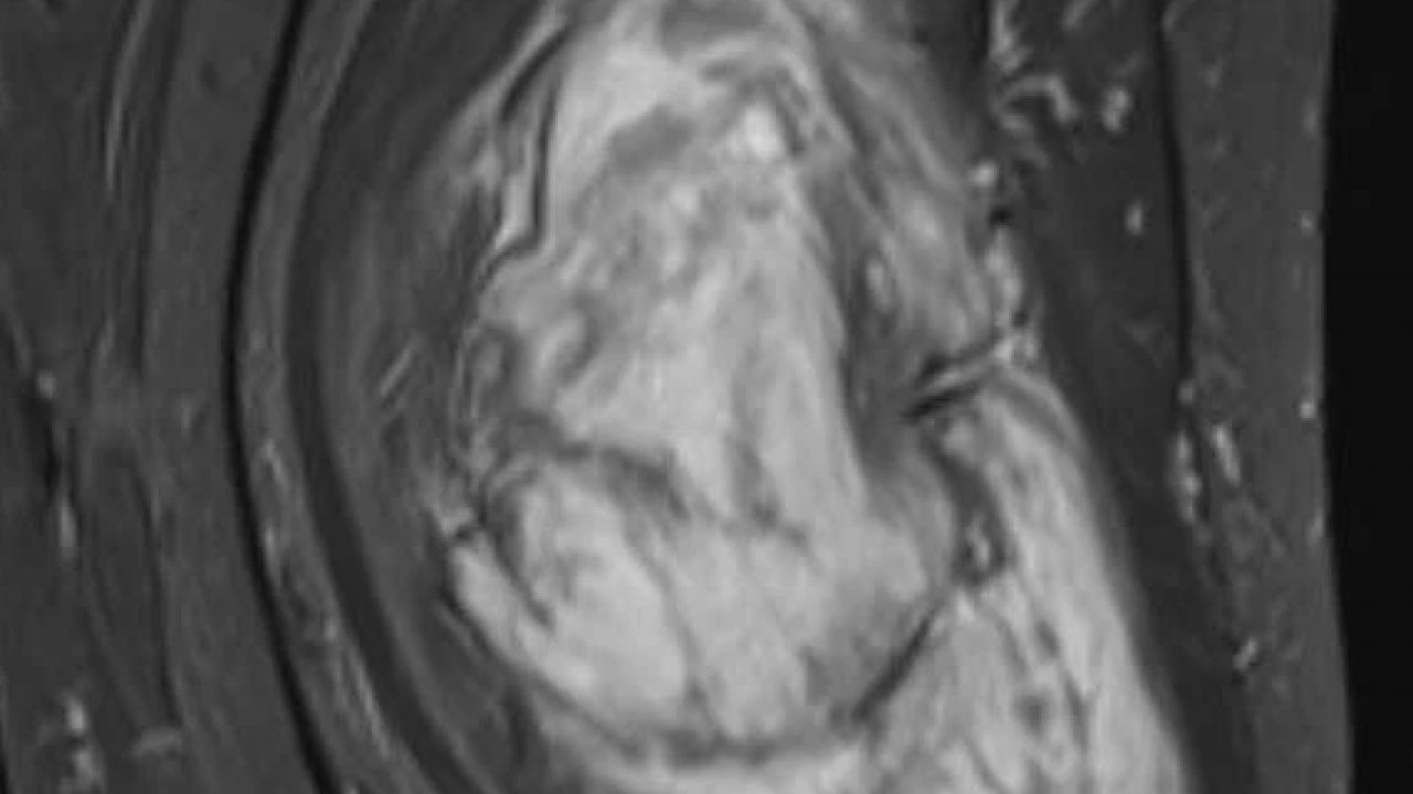 Foto - Doktorlar bile inanamadı! Bacağından çıkan şey tam 5 kilo 668 gram