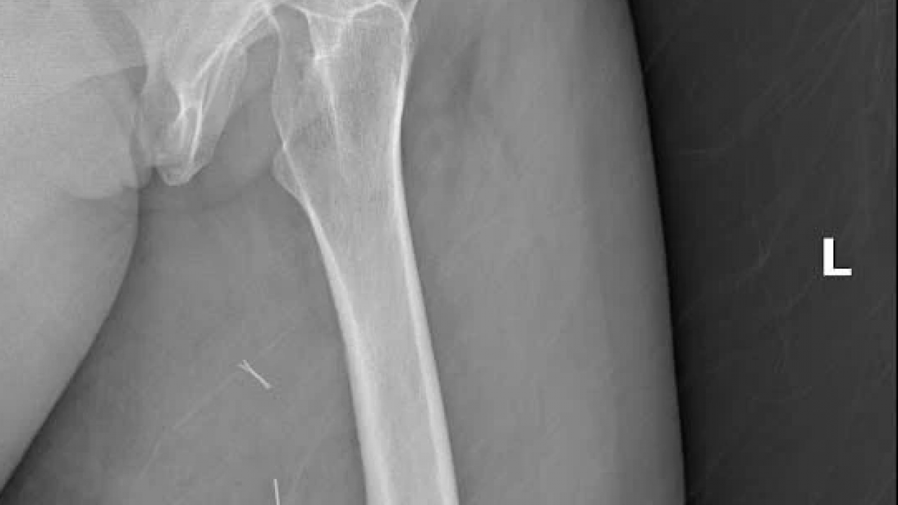 Foto - Doktorlar bile inanamadı! Bacağından çıkan şey tam 5 kilo 668 gram