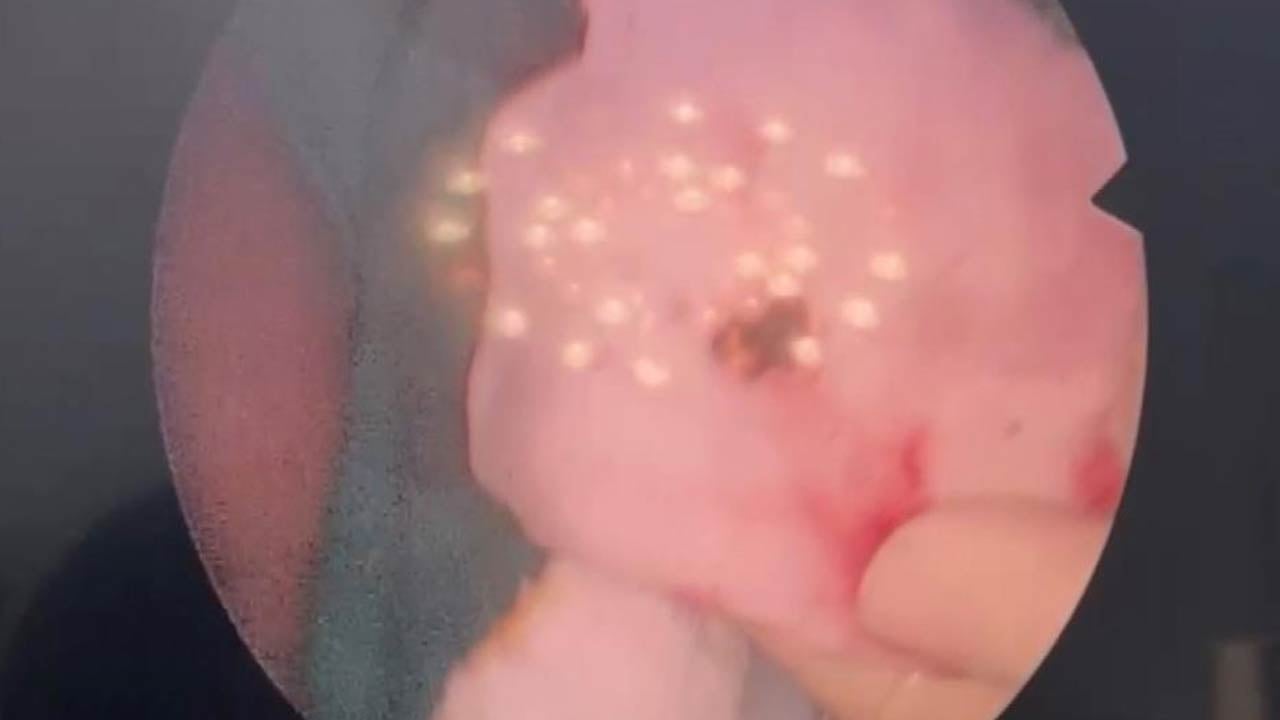 Foto - Doktorlar bile inanamadı... Estetik ameliyatta burundan çıkanlara bakın