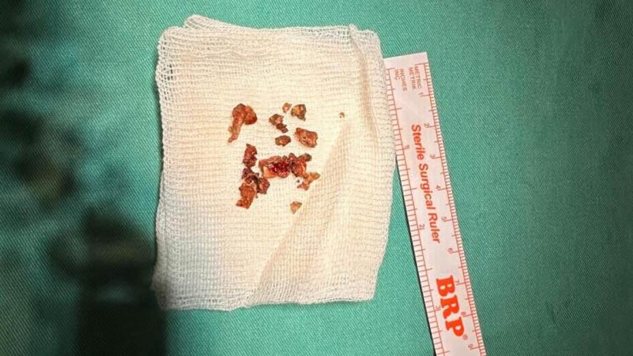 Doktorlar bile inanamadı... Estetik ameliyatta burundan çıkanlara bakın