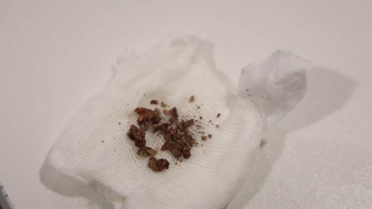 Foto - Doktorlar bile inanamadı... Estetik ameliyatta burundan çıkanlara bakın