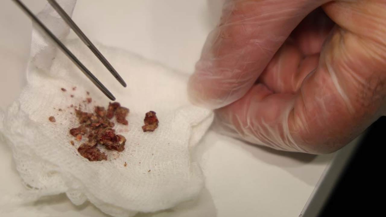 Foto - Doktorlar bile inanamadı... Estetik ameliyatta burundan çıkanlara bakın