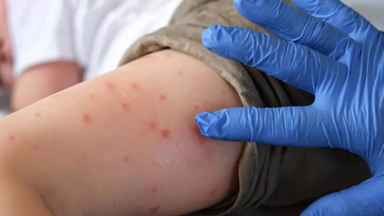 Foto - Dünya Sağlık Örgütü alarmda! Sivrisinekten bulaşıyor tedavisi yok