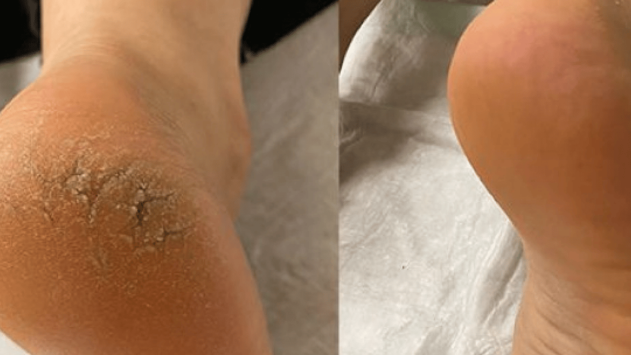 Foto - Eğer topuklarınızda çatlaklar... Gece uyumadan önce ayak tabanına 2 damla sürün! 