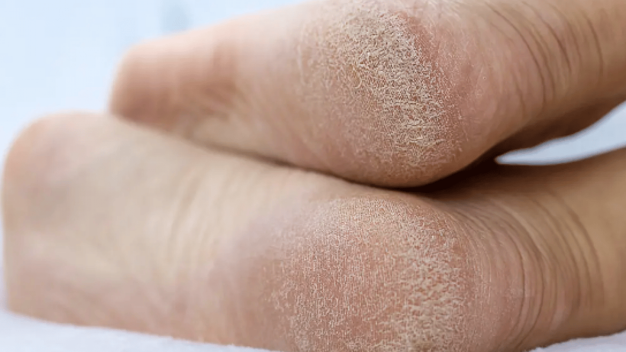 Foto - Eğer topuklarınızda çatlaklar... Gece uyumadan önce ayak tabanına 2 damla sürün! 