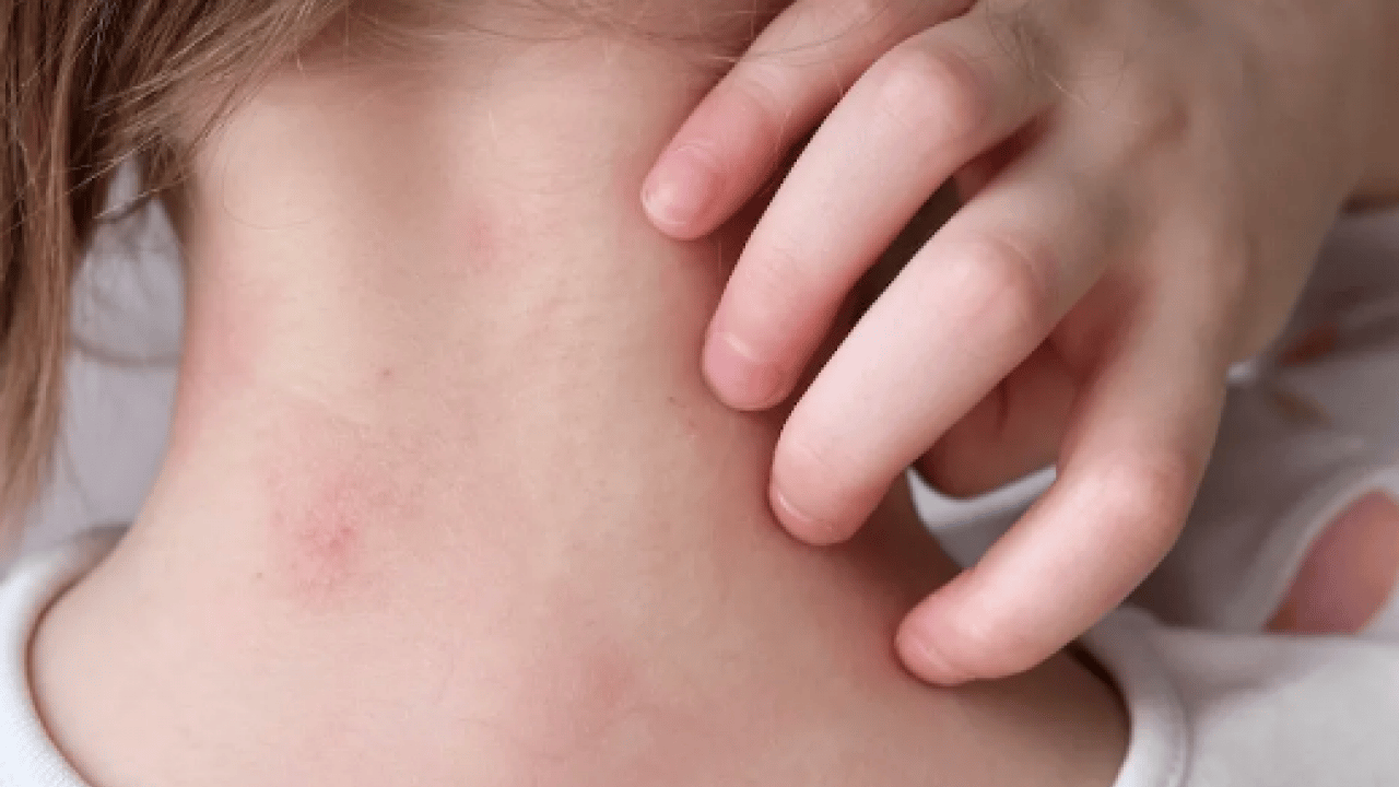 Foto - Egzama derdiniz mi var? Kuyruk yağı kremi egzama tedavisinde sorun oluşturabilir uyarısı...