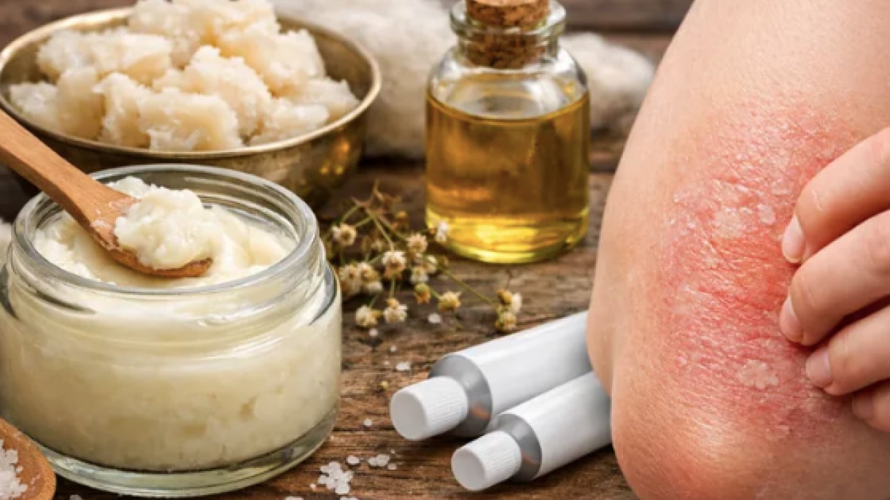 Egzama derdiniz mi var? Kuyruk yağı kremi egzama tedavisinde sorun oluşturabilir uyarısı...