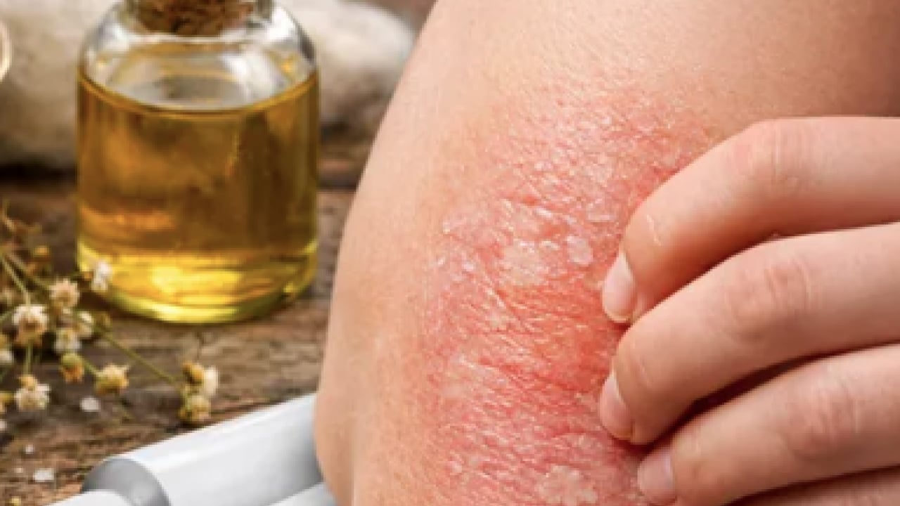 Foto - Egzama derdiniz mi var? Kuyruk yağı kremi egzama tedavisinde sorun oluşturabilir uyarısı...