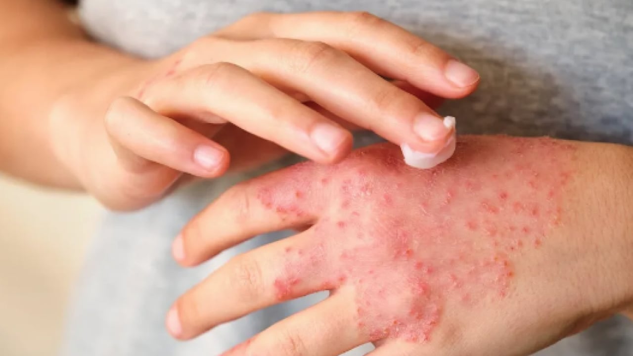 Foto - Egzama derdiniz mi var? Kuyruk yağı kremi egzama tedavisinde sorun oluşturabilir uyarısı...