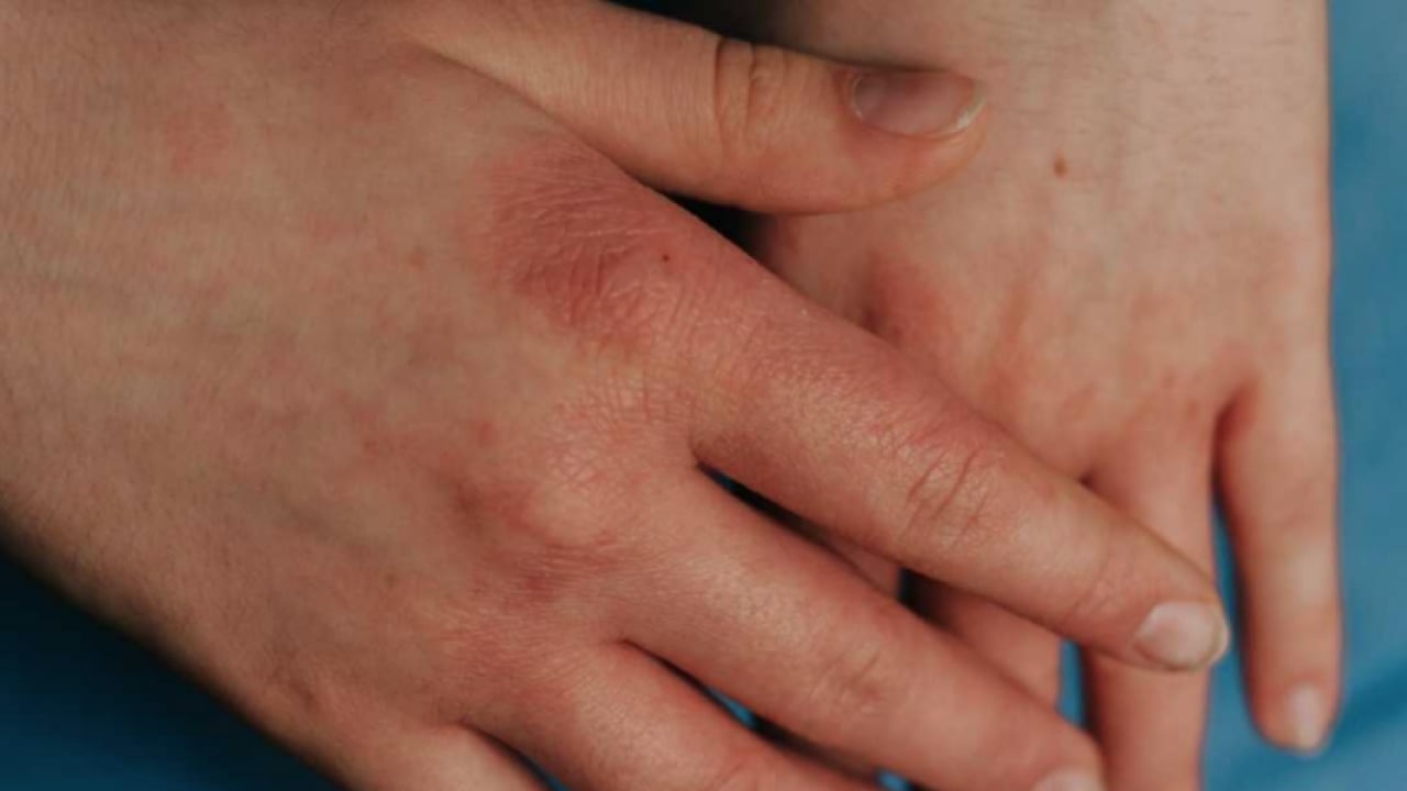 Foto - Egzamadan kurtaran en iyi doğal tedavi olacak: Çarpıcı yolu şaşırttı, görenleri hayrete düşürdü! Bakın nasıl yapılıyor