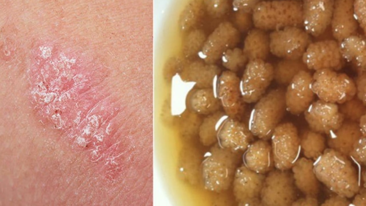 Foto - Egzamadan kurtaran en iyi doğal tedavi olacak: Çarpıcı yolu şaşırttı, görenleri hayrete düşürdü! Bakın nasıl yapılıyor