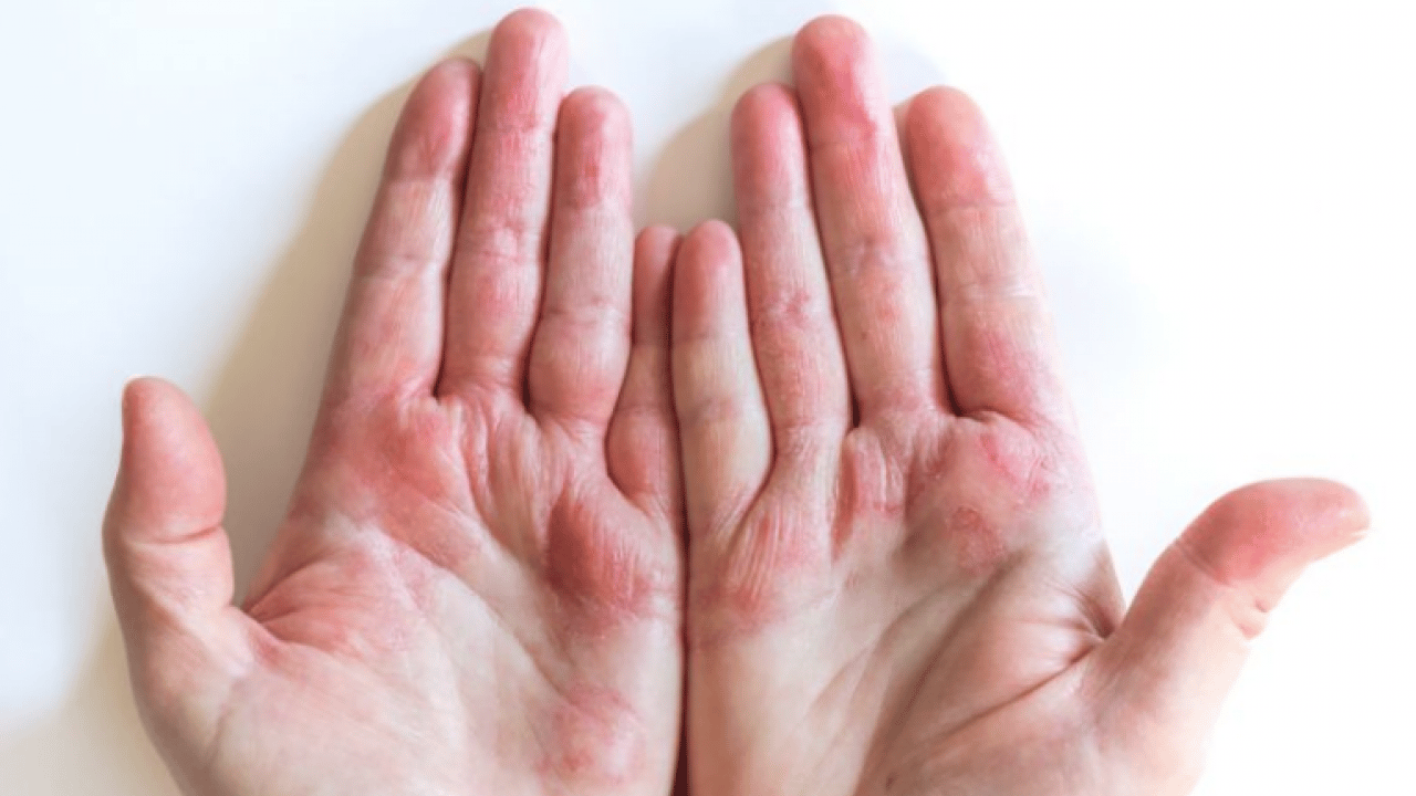 Egzamadan kurtaran en iyi doğal tedavi olacak: Çarpıcı yolu şaşırttı, görenleri hayrete düşürdü! Bakın nasıl yapılıyor