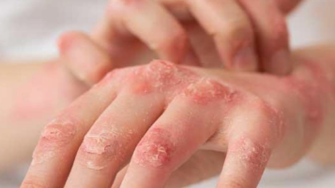 Foto - Egzamadan kurtaran en iyi doğal tedavi olacak: Çarpıcı yolu şaşırttı, görenleri hayrete düşürdü! Bakın nasıl yapılıyor